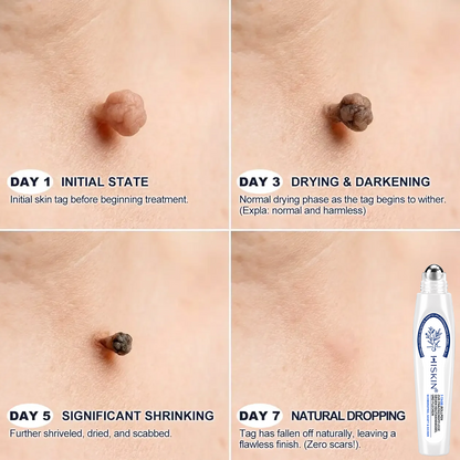 1𝐇𝐈𝐒𝐊𝐈𝐍®👩‍⚕️ 𝟕-𝐓𝐚𝐠𝐞-𝐇𝐚𝐮𝐭𝐚𝐧𝐡ä𝐧𝐠𝐬𝐞𝐥- & 𝐅𝐥𝐞𝐜𝐤𝐞𝐧𝐞𝐧𝐭𝐟𝐞𝐫𝐧𝐞𝐫 – 𝐅𝐨𝐫𝐭𝐬𝐜𝐡𝐫𝐢𝐭𝐭𝐥𝐢𝐜𝐡𝐞𝐫 𝐑𝐨𝐥𝐥-𝐨𝐧-𝐒𝐭𝐢𝐟𝐭 𝐳𝐮𝐫 𝐬𝐜𝐡𝐦𝐞𝐫𝐳𝐟𝐫𝐞𝐢𝐞𝐧 𝐮𝐧𝐝 𝐧𝐚𝐫𝐛𝐞𝐧𝐟𝐫𝐞𝐢𝐞𝐧 𝐄𝐧𝐭𝐟𝐞𝐫𝐧𝐮𝐧𝐠 𝐯𝐨𝐧 𝐇𝐚𝐮𝐭𝐮𝐧𝐫𝐞𝐢𝐧𝐡𝐞𝐢𝐭𝐞𝐧（副本）
